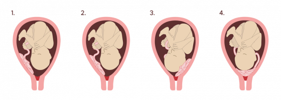 placenta-positions