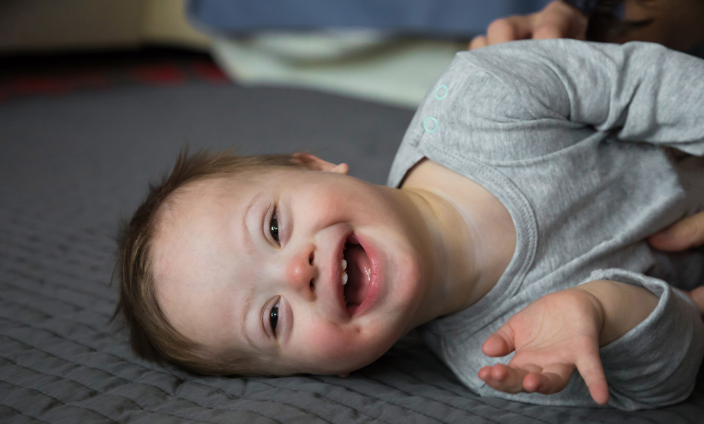 A baby with Down Syndrome