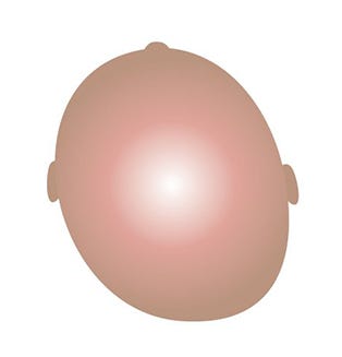 flat head syndrom in babies: Plagiocephaly