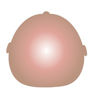 Plagiocephaly: Brachycephaly